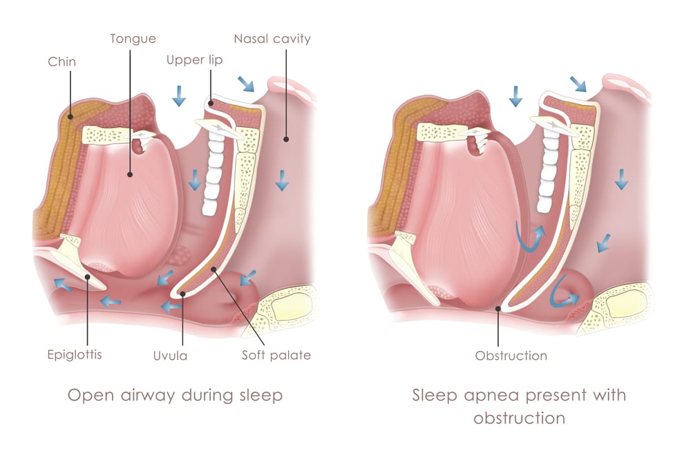 Obesity and Sleep Apnea - Sermo