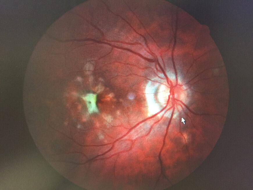 patient-case-white-dot-syndrome